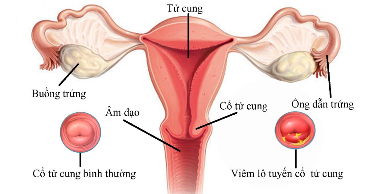 Bệnh Lộ tuyến cổ tử cung: Nguyên nhân, biến chứng và cách điều trị